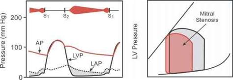 pressure volume loop mitral stenosis